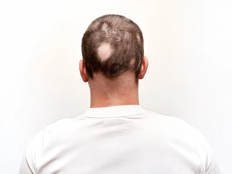 palvikaljuus ja sen hoito